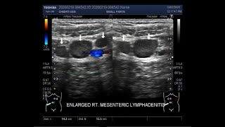 Ultrasound Video showing Mesenteric lymphadenitis enlarged mesenteric lymph nodes [upl. by Aneele]