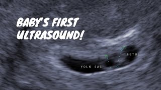 4D Ultrasound of Baby at 29 Weeks  itsJudysLife [upl. by Allehc]