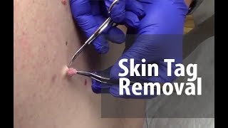 Skin Tag Removal  Dr Derm [upl. by Rosalind914]