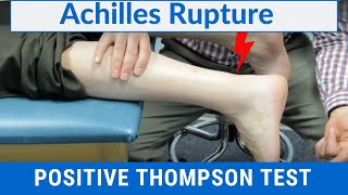 How to Perform a Thompson Test on a Patient with a COMPLETE ACHILLES RUPTURE [upl. by Aramoj699]