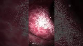 Colon Polypectomy Polyp Removal [upl. by Marquis522]