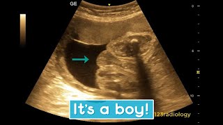 Ultrasound showing boy baby [upl. by Alael]