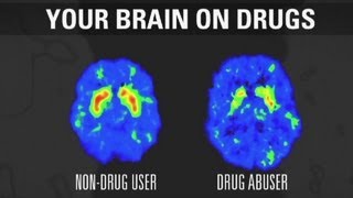 How addiction changes your brain [upl. by Lekar]