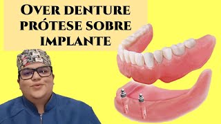 Overdenture uma prótese sobre implante Dra Bianca Rosa [upl. by Glenine418]