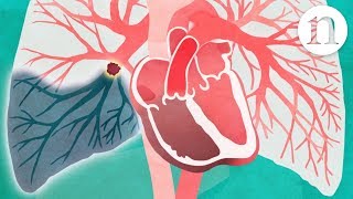 Pulmonary embolism The route to recovery [upl. by Nevada]