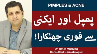 How To Remove Pimples Overnight  Acne Treatment  Pimple Khatam Karne Ka Tarika [upl. by Rramel621]