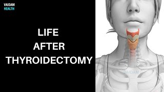 Life after Thyroidectomy [upl. by Iahk]