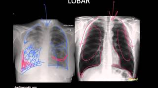 Pneumonia Imaging [upl. by Ramunni]