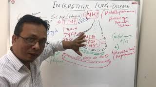 Interstitial lung diseasepathophysiology [upl. by George674]