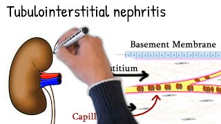 Tubulointerstitial nephritis made simply interstitial nephritis [upl. by Wileen316]