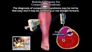 Bedside Fasciotomy For Compartment Syndrome  Everything You Need To Know  Dr Nabil Ebraheim [upl. by Novyaj]