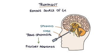 Understanding Acromegaly [upl. by Cinom329]