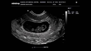 Ultrasound scan pregnancy 8 weeks File OB1 [upl. by Briant]