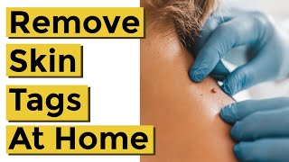 How to Quickly and Easily Remove Skin Tags at Home Using Things You Already Own [upl. by Grata]