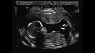 16 Weeks Pregnant Ultrasound [upl. by Mckinney]