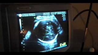 My Growth Scan Follow Up Ultrasound [upl. by Golden]