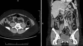 mesenteric adenitis [upl. by Joete]