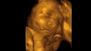 How To OB Ultrasound  Normal Pregnancy Case Study Video [upl. by Jeniffer360]