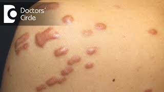 What is the best treatment for Keloid in young people  Dr Pavan Murdeshwar [upl. by Lindblad808]