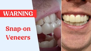 Snap On Veneers Warning [upl. by Nolahs]