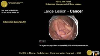 The large colon polyp When to choose EMR ESD or fullthickness resection [upl. by Redford]