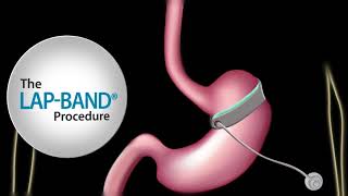 Fast Facts about The LAPBAND® procedure [upl. by Doll]