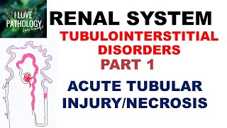 ACUTE TUBULAR INJURYNECROSIS or ACUTE KIDNEY INJURY  Pathology [upl. by Nnairret663]